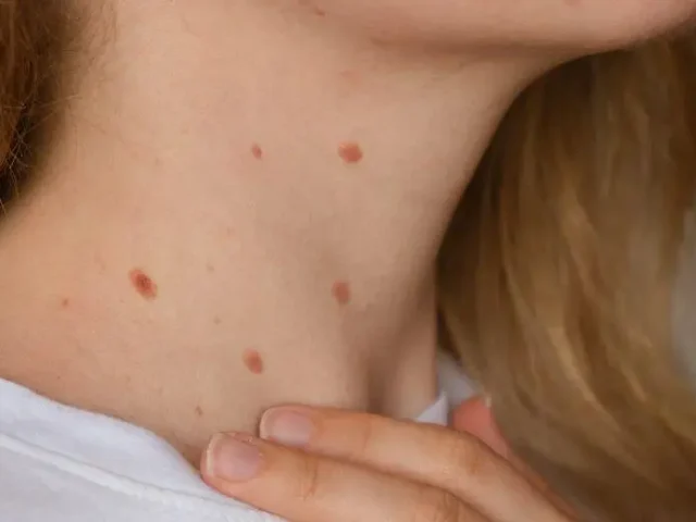 Struggling with Stubborn Warts That Just Won’t Go Away?