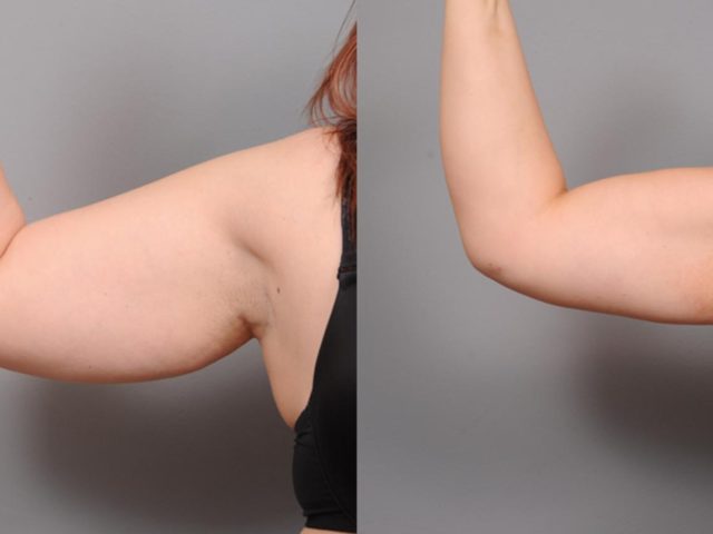 Arm Liposuction: How to Achieve Toned Arms