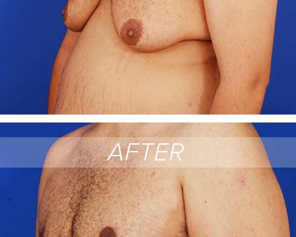 Gynecomastia Surgery: Everything You Need to Know About Male Breast Reduction